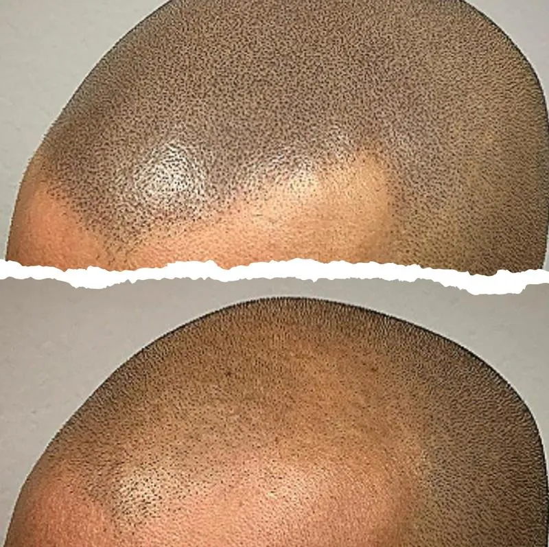 Jak radzić sobie z kreską na brzuchu po porodzie? Praktyczne porady dla mam