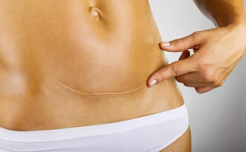 Jak radzić sobie ze zrostami po porodzie? Praktyczne porady i wsparcie