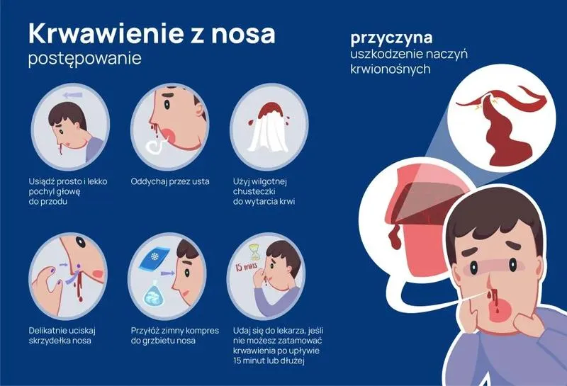 Krwawienie z nosa u dziecka – przyczyny i skuteczne sposoby na pomoc