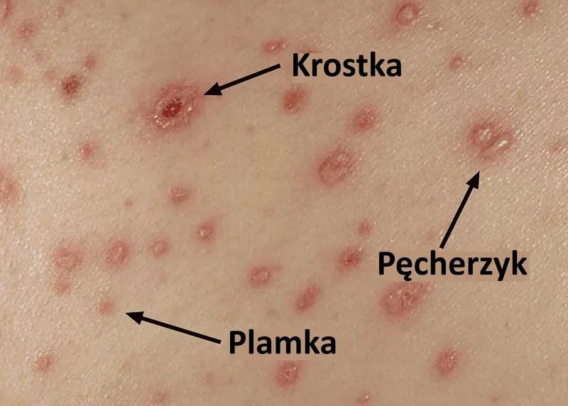 Rodzeństwo dziecka z ospą a przedszkole – co warto wiedzieć?