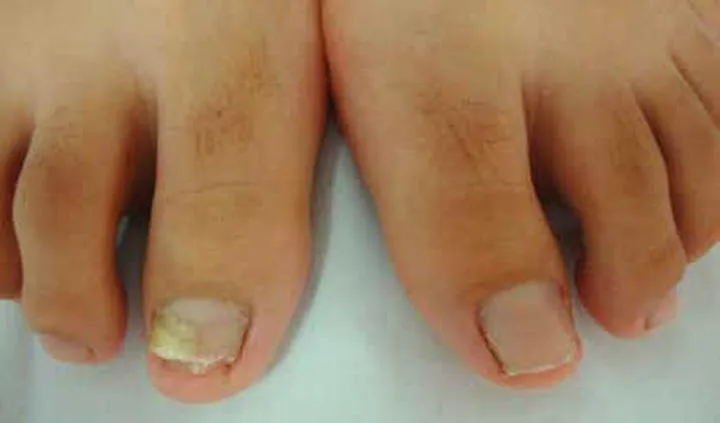 Skuteczne metody leczenia grzybicy paznokci u dzieci – co warto wiedzieć?