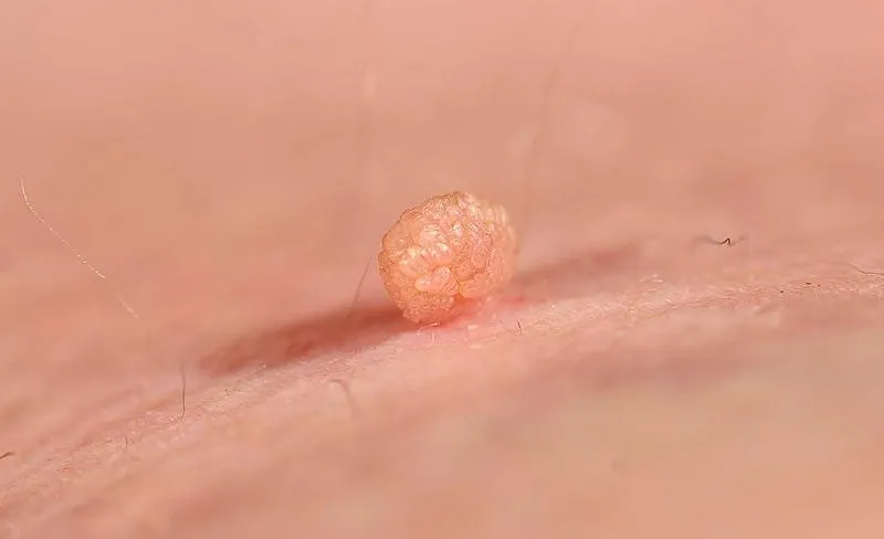 Skuteczne sposoby na usunięcie kurzajek w ciąży – co warto wiedzieć?