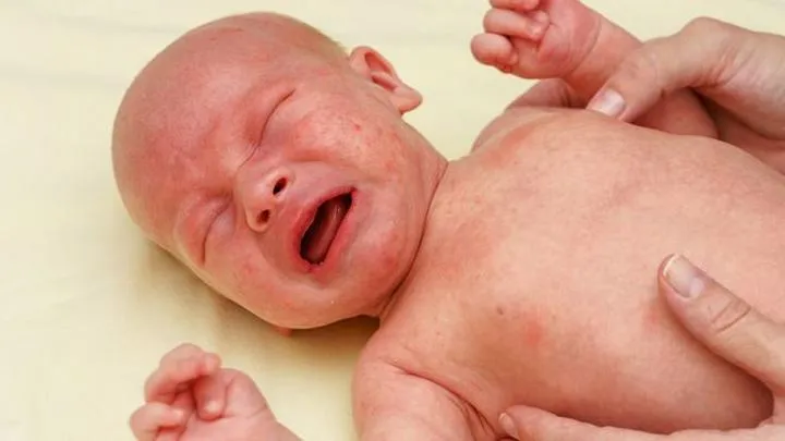 Gorączka u dzieci z alergią