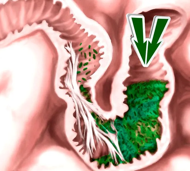 Leczenie zrostów po cesarskim cięciu