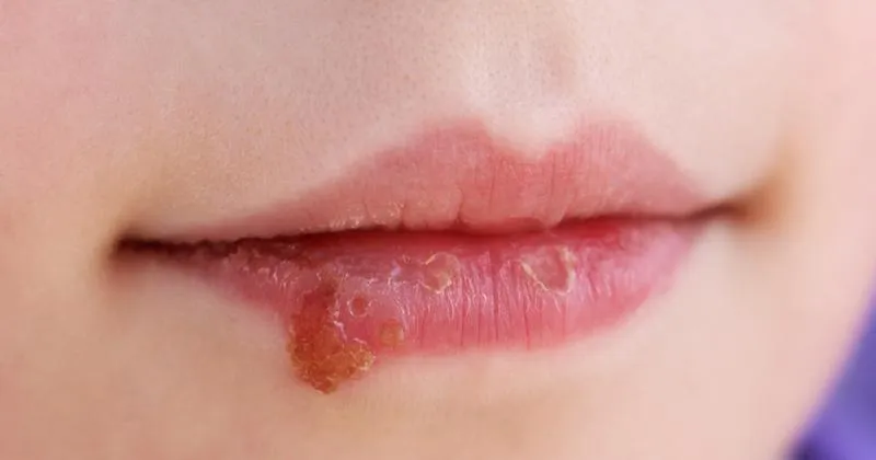 Objawy i diagnoza opryszczki u dzieci