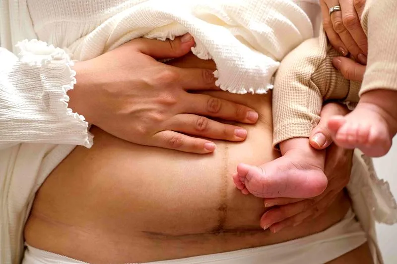 Objawy zrostów po porodzie