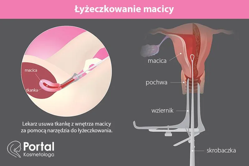 Oczyszczanie macicy po porodzie