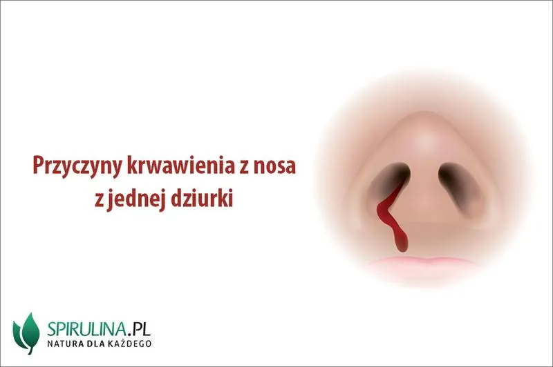 Pierwsza pomoc przy krwawieniu z nosa