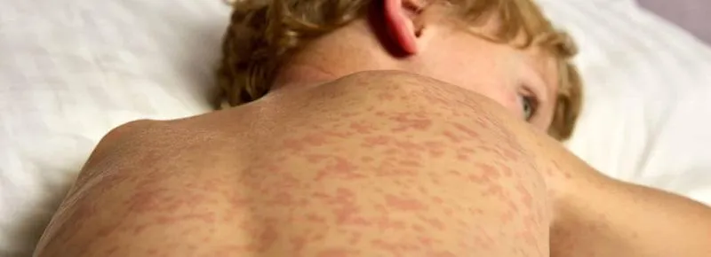 Półpasiec u dzieci