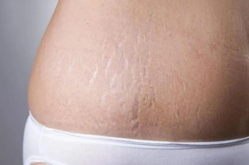 Przyczyny rozstępów po porodzie