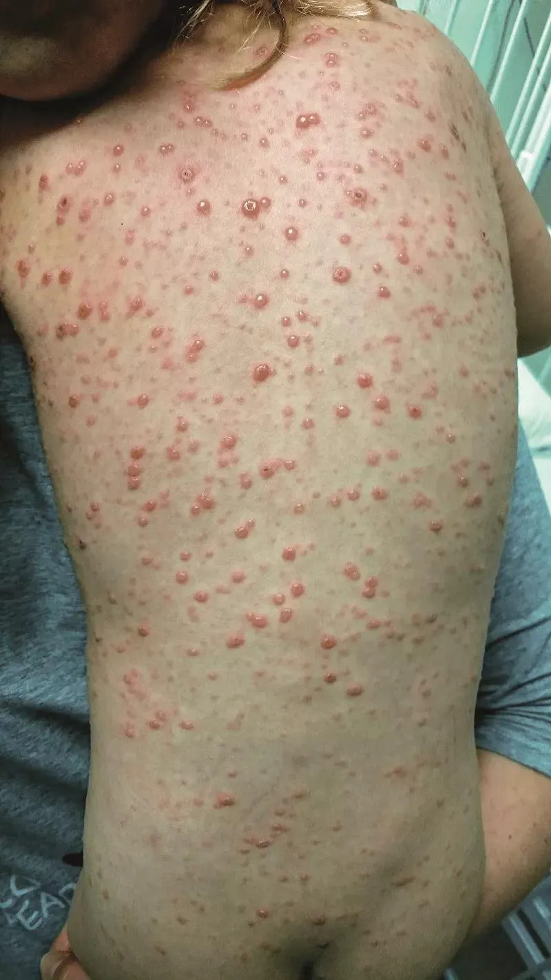 Rodzeństwo dziecka z ospą