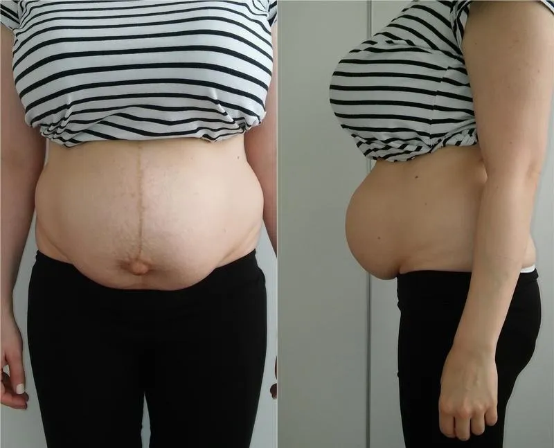 Rozejście mięśnia prostego brzucha w ciąży