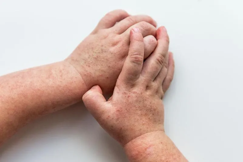 Wpływ szkarlatyny na laktację